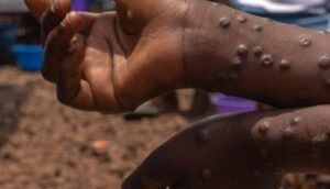 URGENT – Santé : Deuxième cas confirmé de Mpox à Dakar