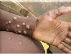 Epidémies de Mpox et de la Fièvre de la Vallée du Rift, 245 cas confirmés