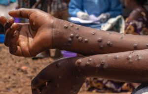 le ministère de la Santé fait le point sur la situation épidémiologique
